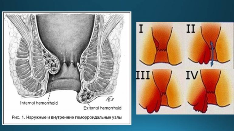 Внутренний геморрой