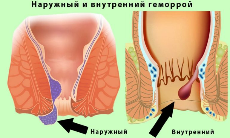 Меновазин при лечении геморроя