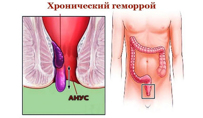 Лечение геморроя 