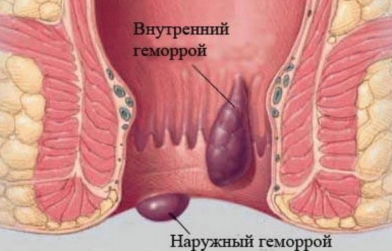 Можно ли раз и навсегда избавиться от геморроя?