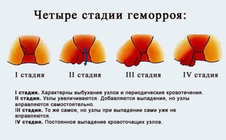 Геморрой