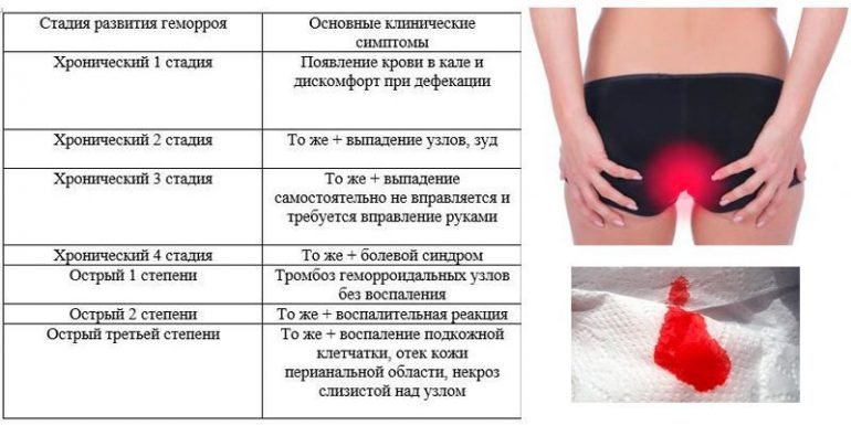 Внутренний геморрой