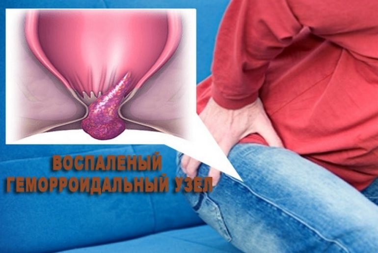 Геморроидальные узлы