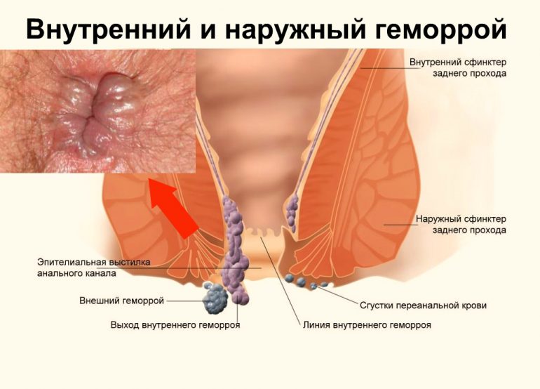 Как лечить геморрой с помощью чистотела?