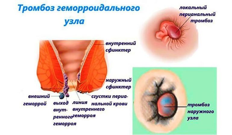 Острый геморрой