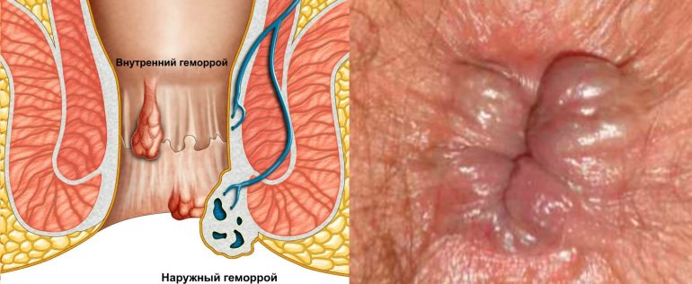 Симптомы и лечение ущемления геморроидального узла