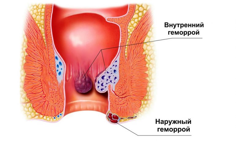 Основные причины и факторы геморроя
