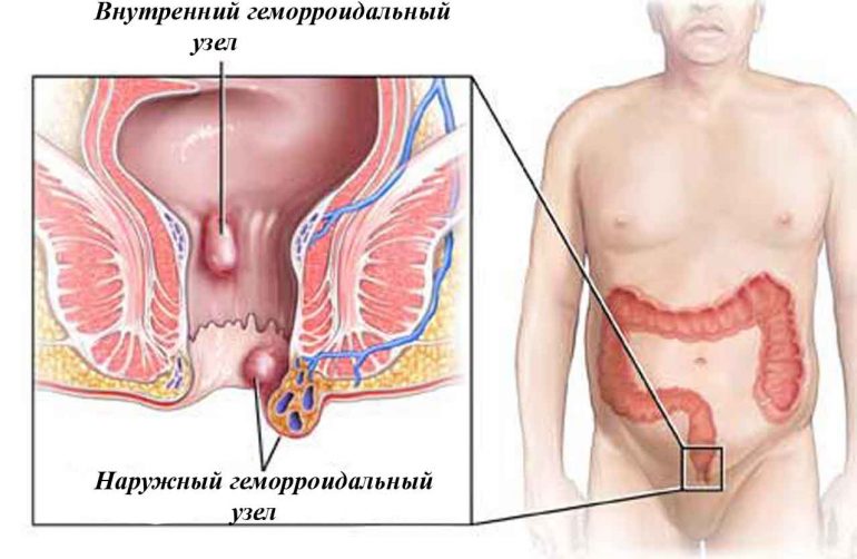 Народная медицина против геморроя