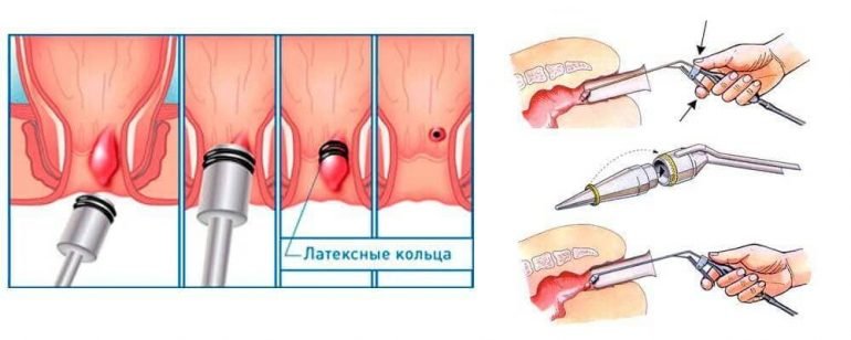 Лигирование