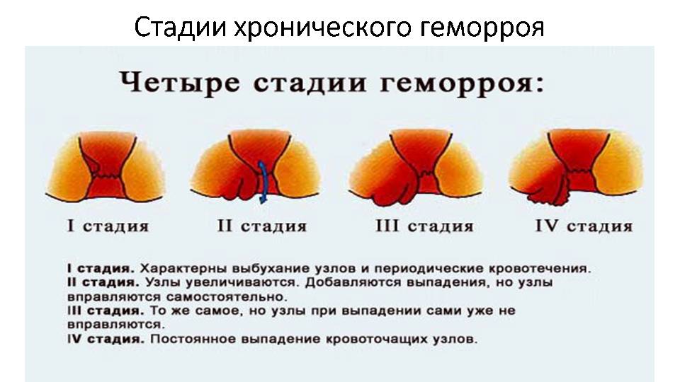 Причины четвертой стадии геморроя