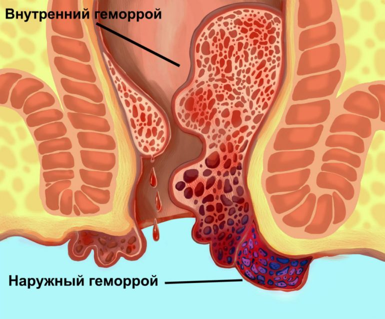 Виды геморроя