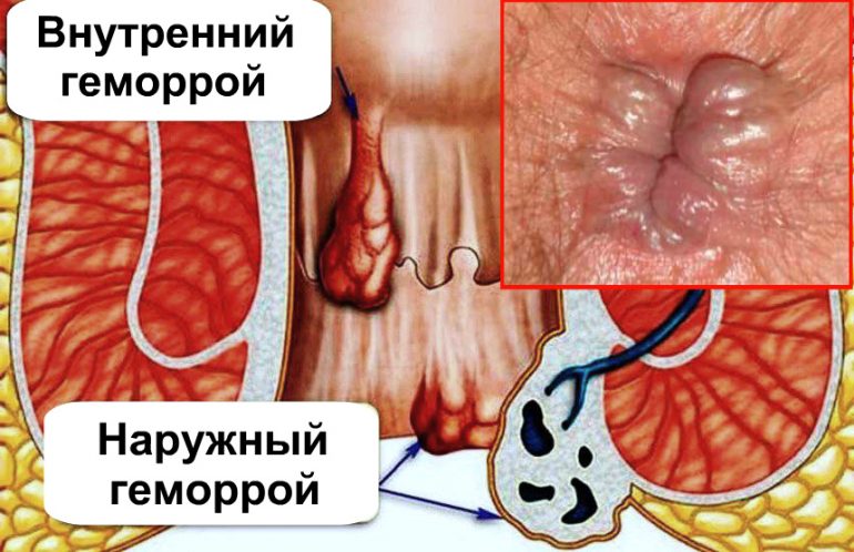 Особенности лечения 