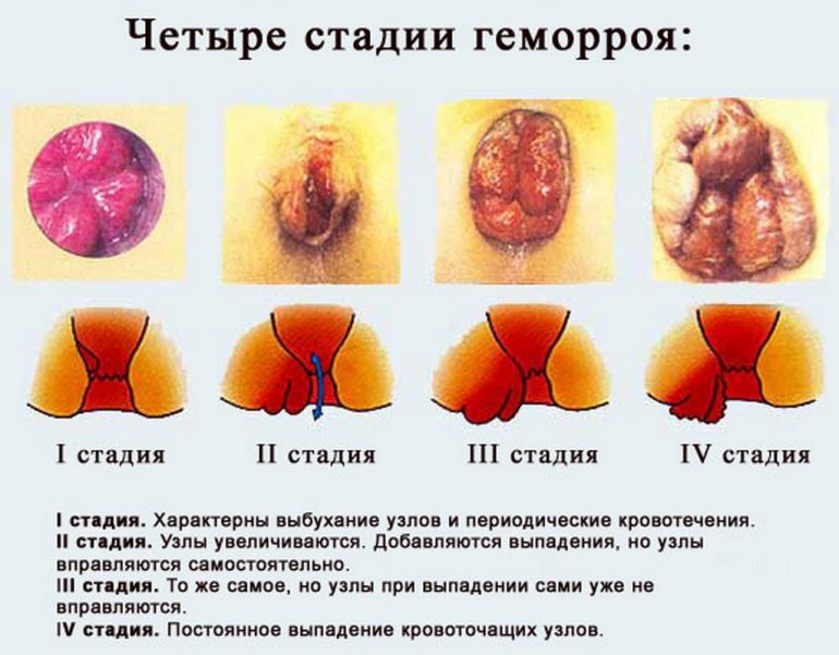Кому показано лечение геморроя дарсонвалем?