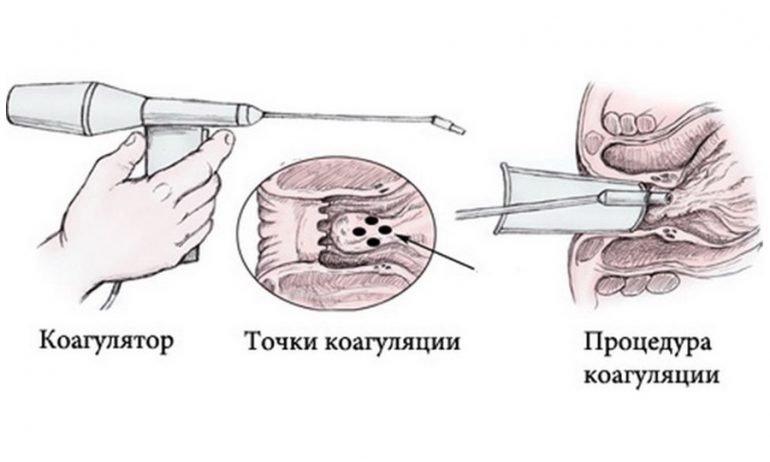 Техника выполнения инфракрасной коагуляции при геморрое