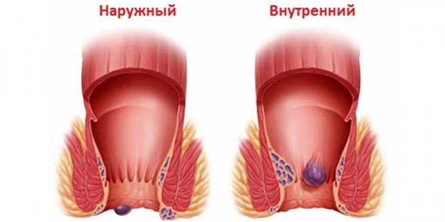 Виды геморроя 