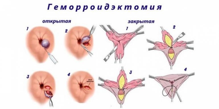 Ультразвуковое лечение геморроя