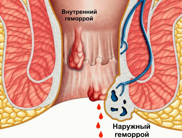 Показания к применению мази при геморрое Безорнил
