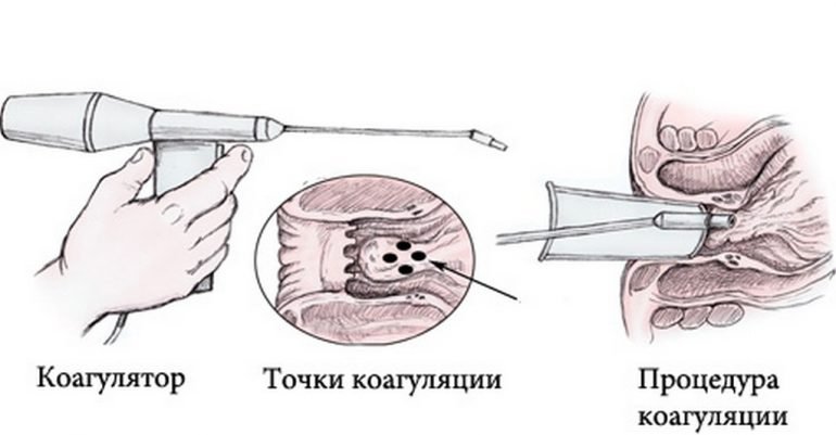 Малоинвазивные способы