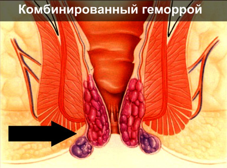 Провокаторы появления геморроя 