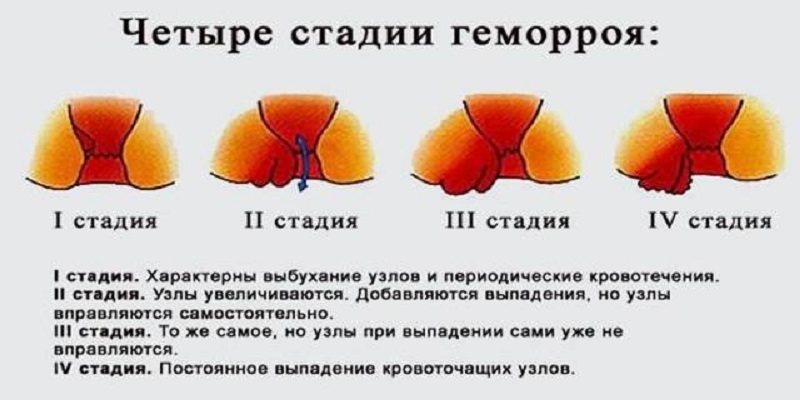 стадии геморроя