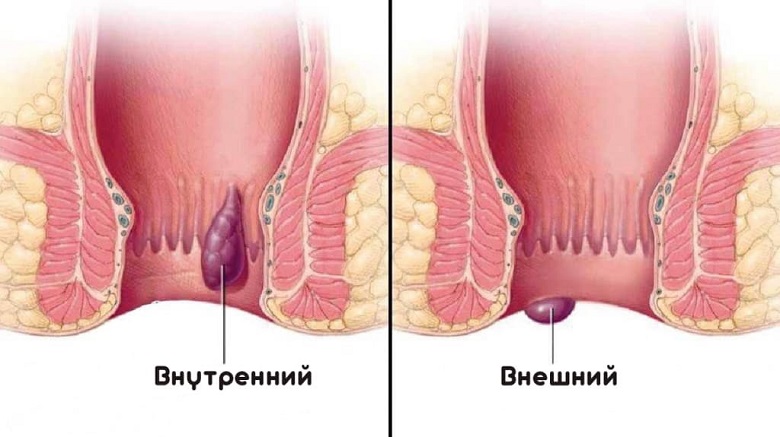 типы геморроя 