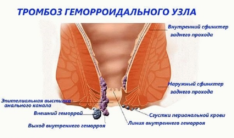 геморрой в разрезе