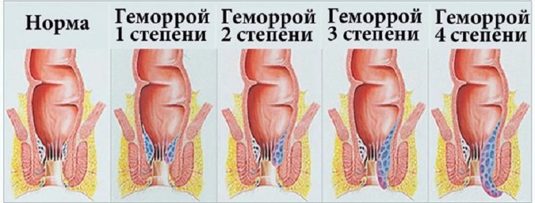 стадии геморроя