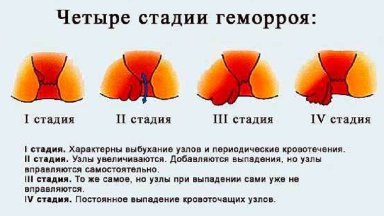 стадии геморроя