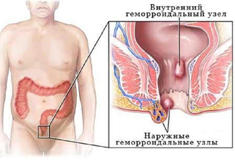 геморрой в разрезе