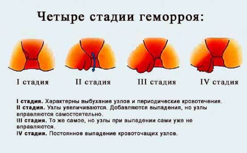 стадии геморроя