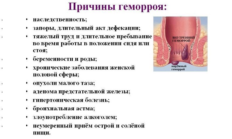 Признаки геморроя